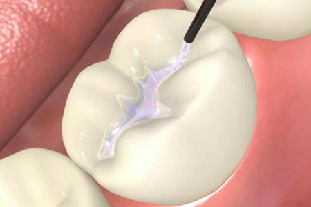 Неинвазивная герметизация фиссур в стоматологии