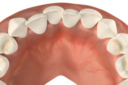 Скученность зубов: разновидности, причины, лечение