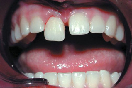 Вывих зуба: причины, симптомы, методы восстановления