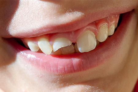 Перелом зуба: причины, симптомы, лечение